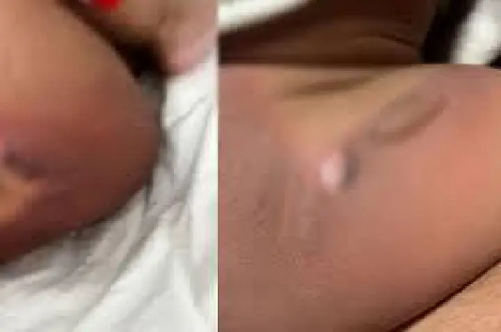 Bebê de 11 meses sofre graves queimaduras durante banho em creche