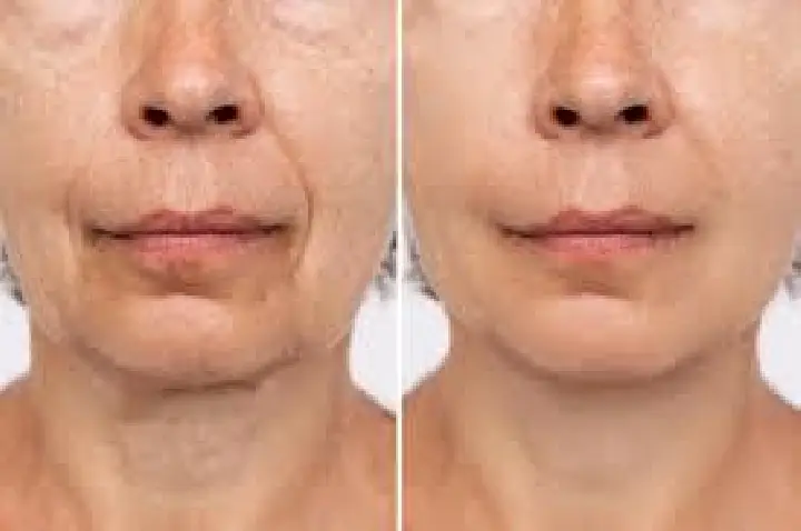 Bioestimulador de colágeno: força que nem sempre sabe que precisa