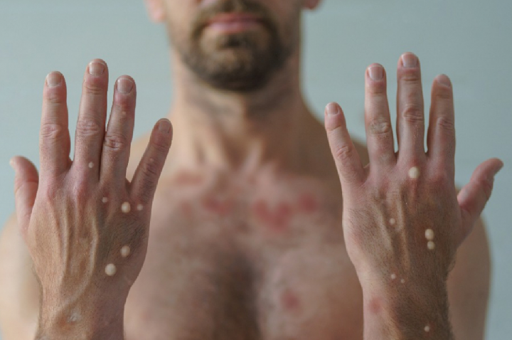 Casos de mpox voltam a crescer no Brasil e chegam a 149