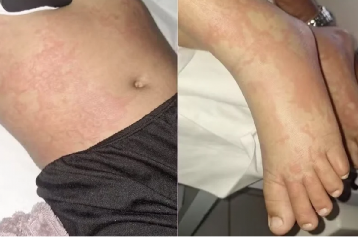 Criança contrai infecção após contato com detergente Ypê