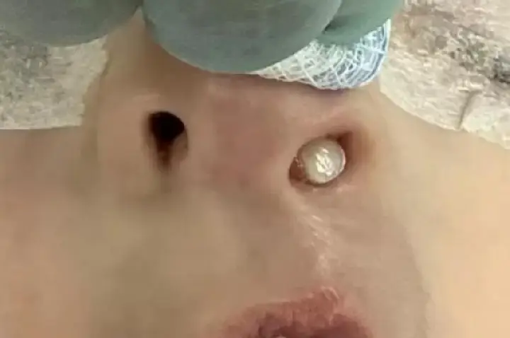 Dente nasce no nariz de criança e choca especialistas
