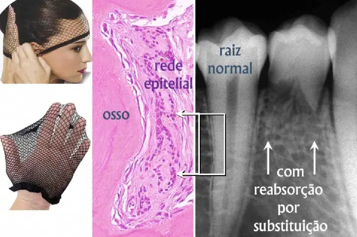 Dente traumatizado reabsorve e o osso substitui