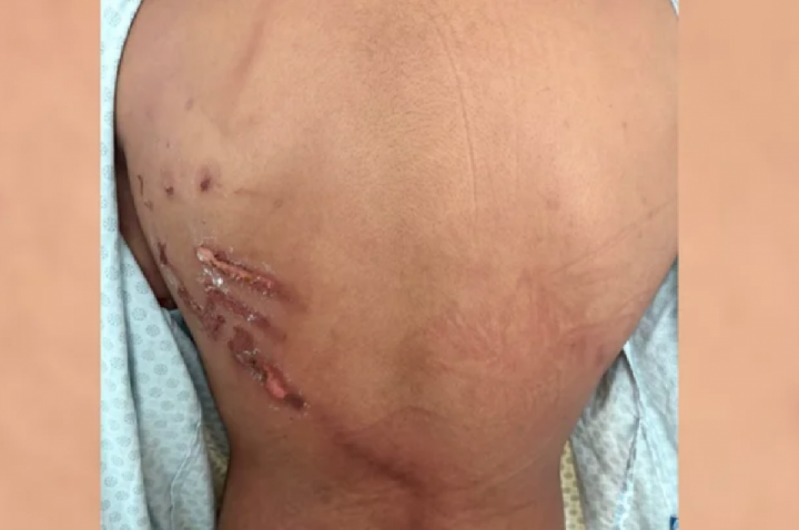 Descarga elétrica rasgou costas de jovem em manifestação; VÍDEO