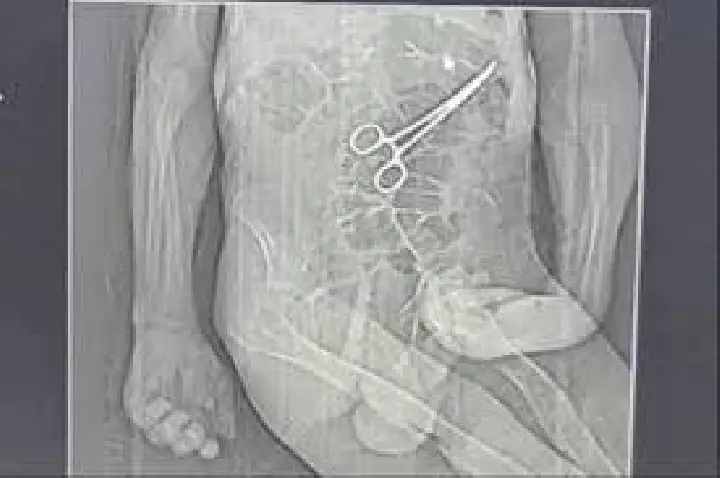 Família acusa hospital de esquecer pinça em corpo de idoso