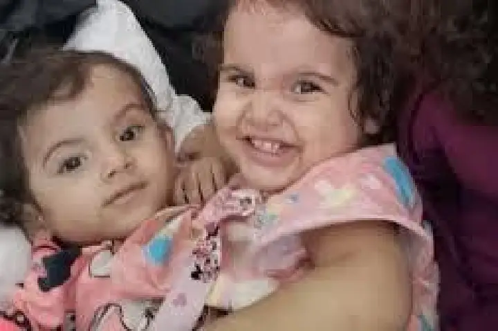 Gêmea siamesa não resiste e morre após 19h de cirurgia