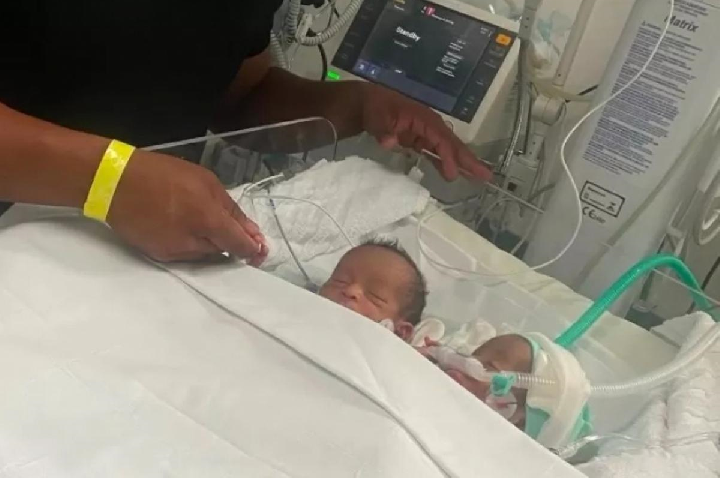 Gêmeos siameses ligados pelo abdômen morrem após infecção
