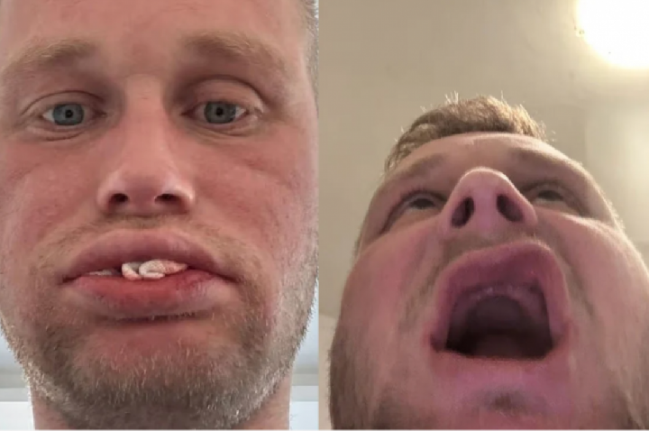 Homem vai à Turquia fazer implante dentário e volta banguela