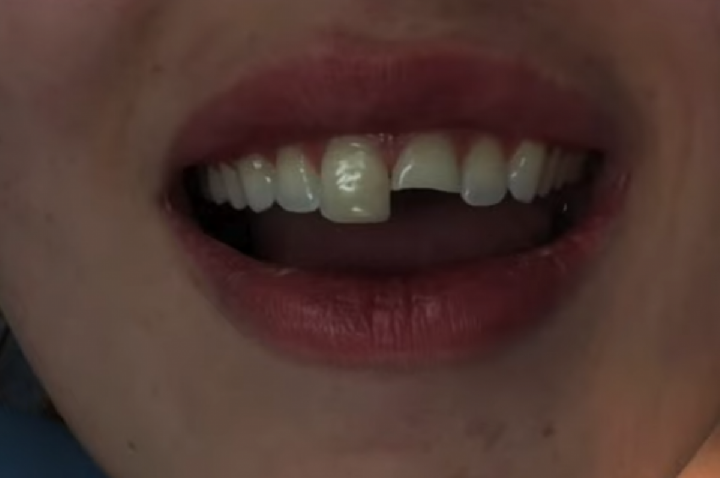 Jovem quebra dente na balada, cola e volta para a festa; VÍDEO