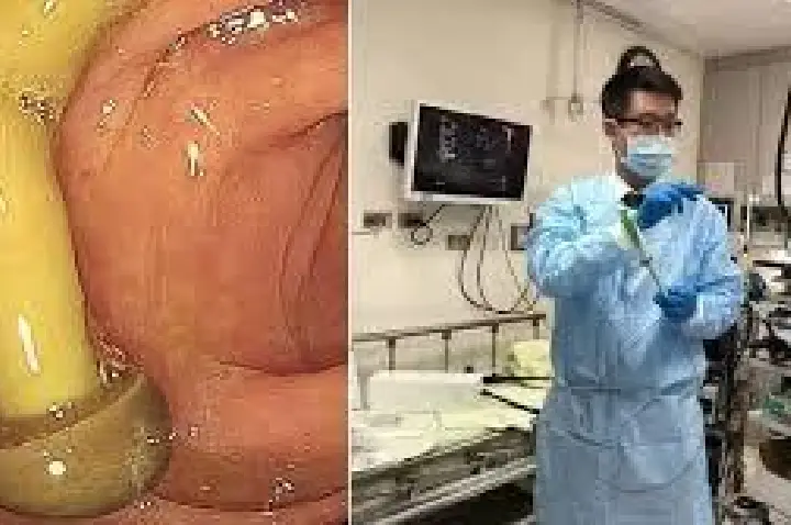 Médico faz alerta ao ver cogumelo inteiro dentro de paciente
