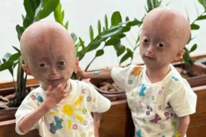 Morre Elis, gêmea com síndrome de envelhecimento precoce