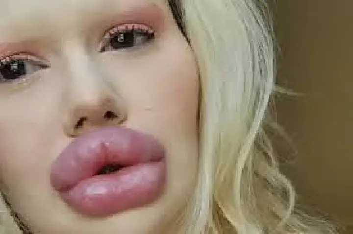 Mulher com 'maiores lábios do mundo' procura por dentista
