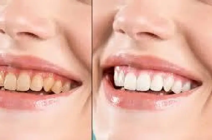 O enigma do dente escurecido