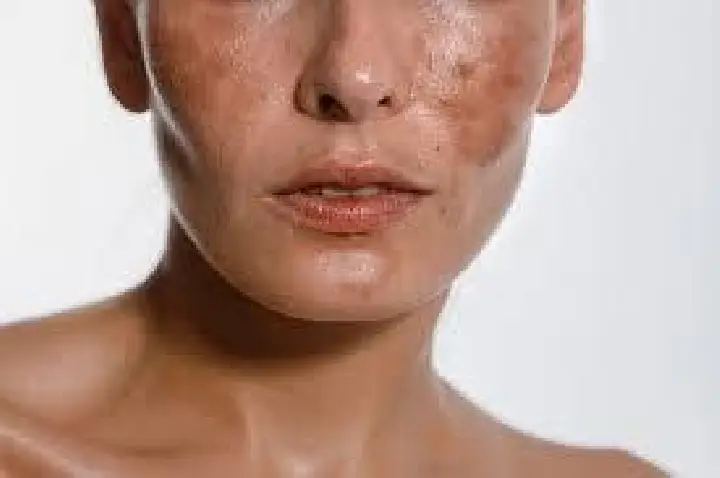 O que você precisa saber sobre melasma