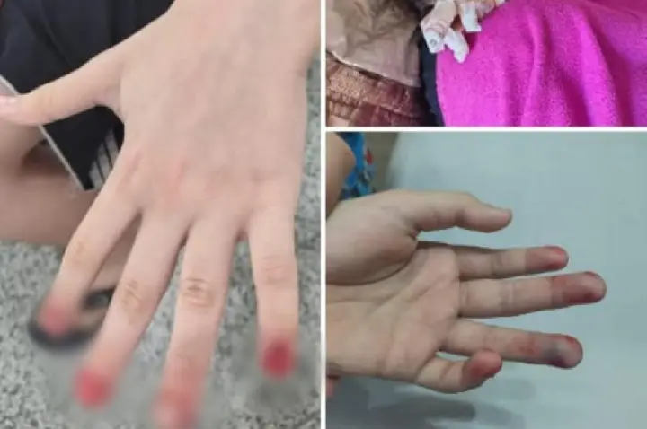 Pai diz que escola não socorreu filho com dedos presos em porta