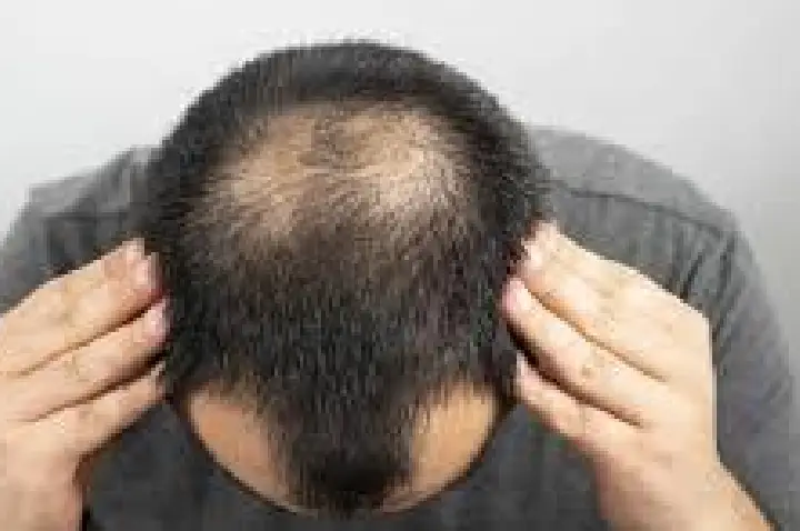 Queda de cabelo em homens jovens: como identificar e cuidar