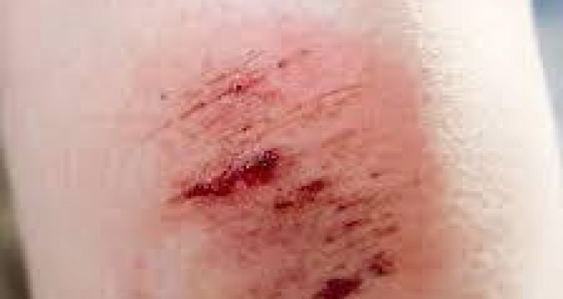 Ferida que sangra e não cicatriza pode sinalizar um câncer de pele