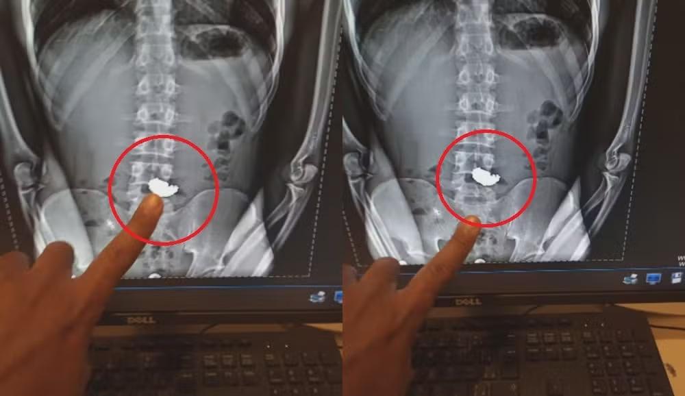 Ladrão é preso depois de furtar e engolir correntinha em BH; raio-x mostra objeto no estômago