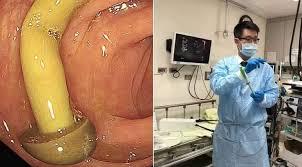 Médico faz alerta ao ver cogumelo inteiro dentro de paciente