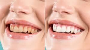 O enigma do dente escurecido