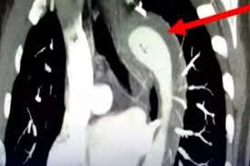 Ela teve org@smo tão intenso que rompeu aorta parou no hospital