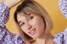 Isotretinoína contra acne: entenda o tratamento