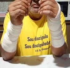 Idoso sofre graves ferimentos com ataque de pitbull em Bauru