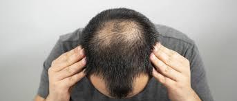 Queda de cabelo em homens jovens: como identificar e cuidar