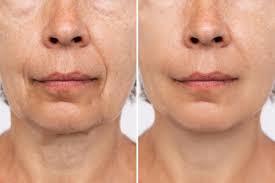 Bioestimulador de colágeno: força que nem sempre sabe que precisa