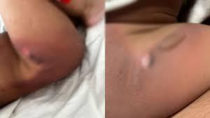 Bebê de 11 meses sofre graves queimaduras durante banho em creche