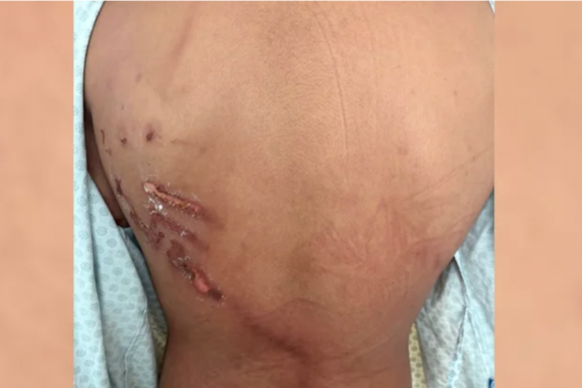 Descarga elétrica rasgou costas de jovem em manifestação; VÍDEO