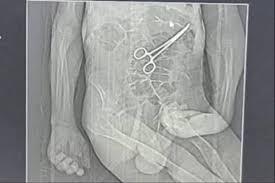 Família acusa hospital de esquecer pinça em corpo de idoso