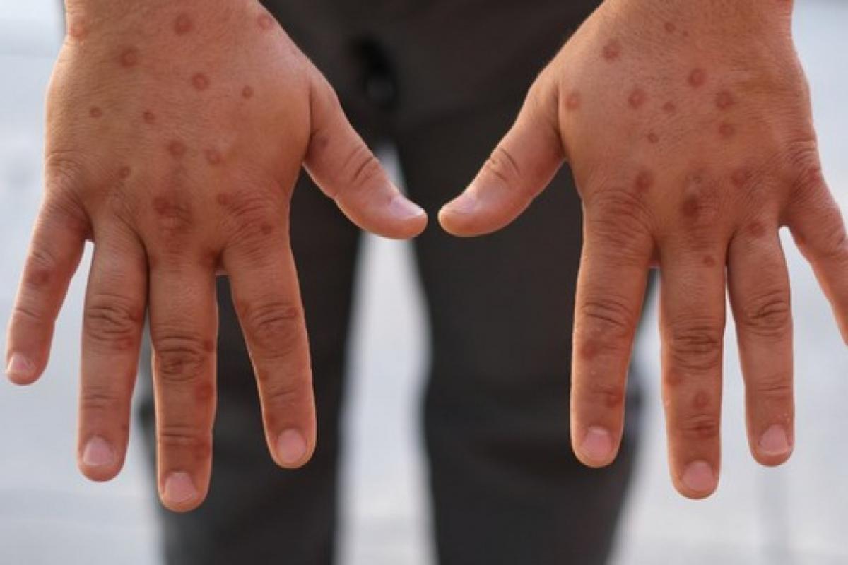 Casos de mpox mais que dobram em 20 dias, com 129 confirmações