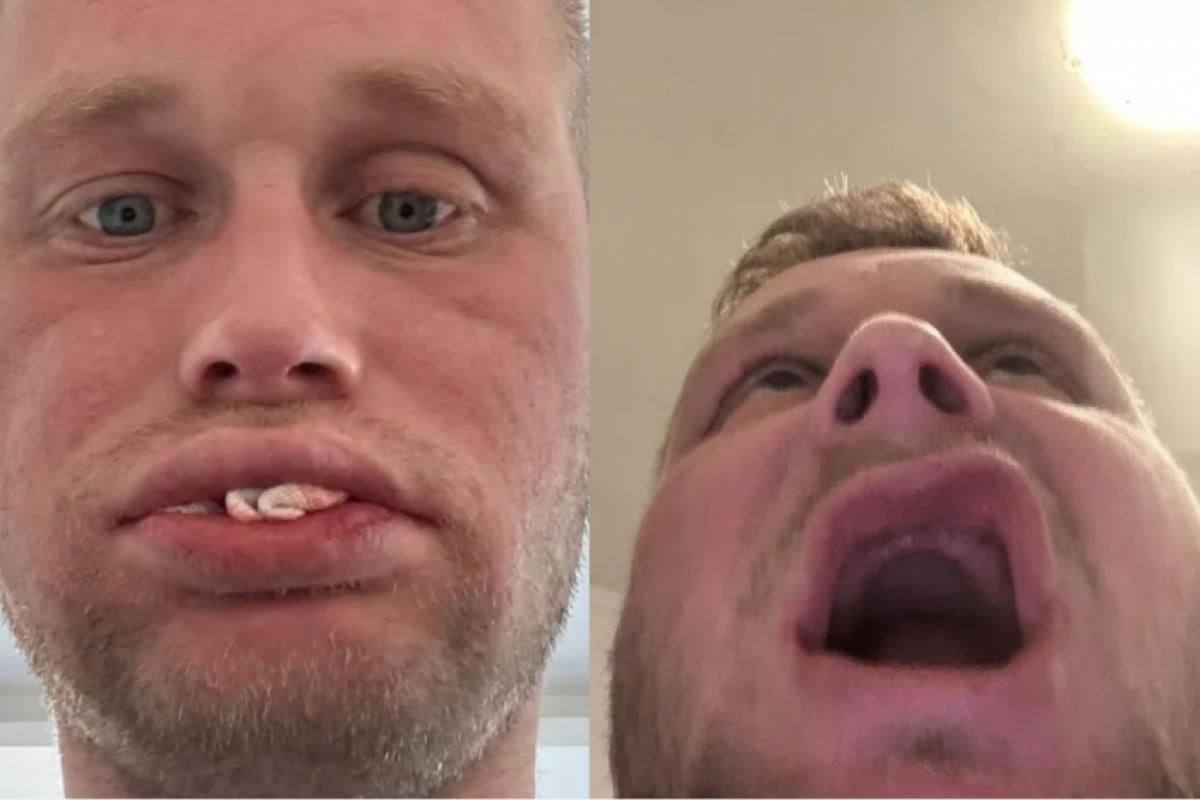 Homem vai à Turquia fazer implante dentário e volta banguela