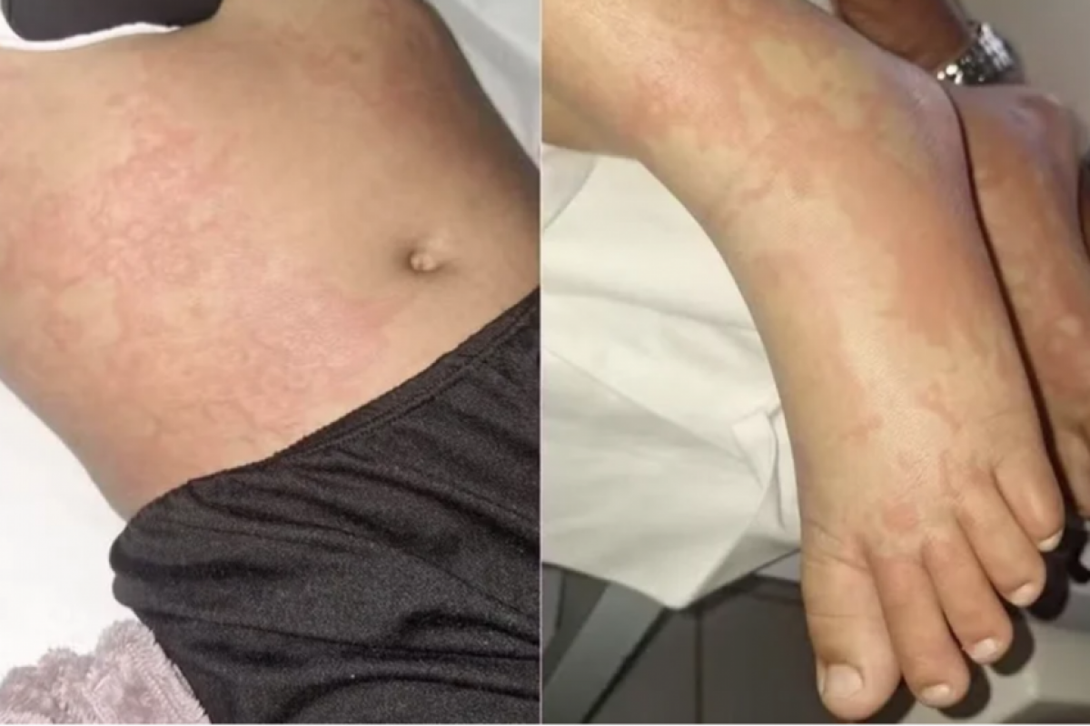 Criança contrai infecção após contato com detergente Ypê