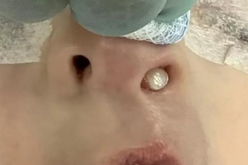 Dente nasce no nariz de criança e choca especialistas