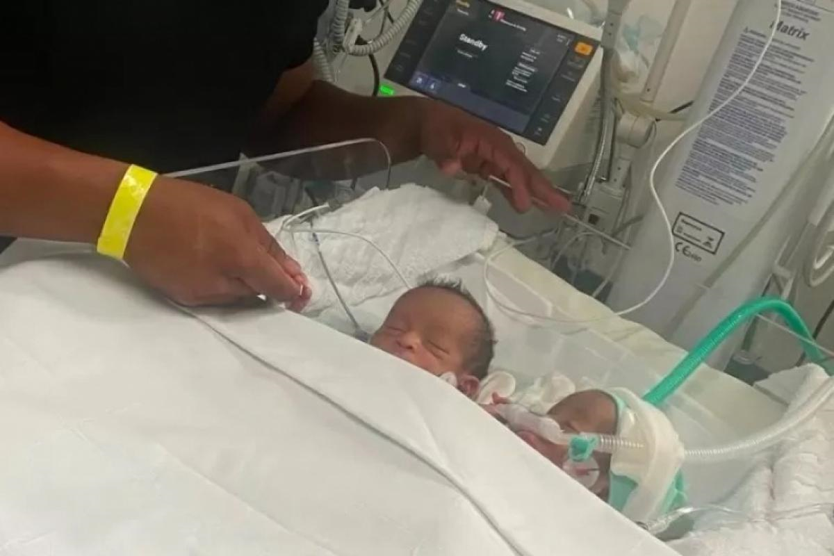 Gêmeos siameses ligados pelo abdômen morrem após infecção