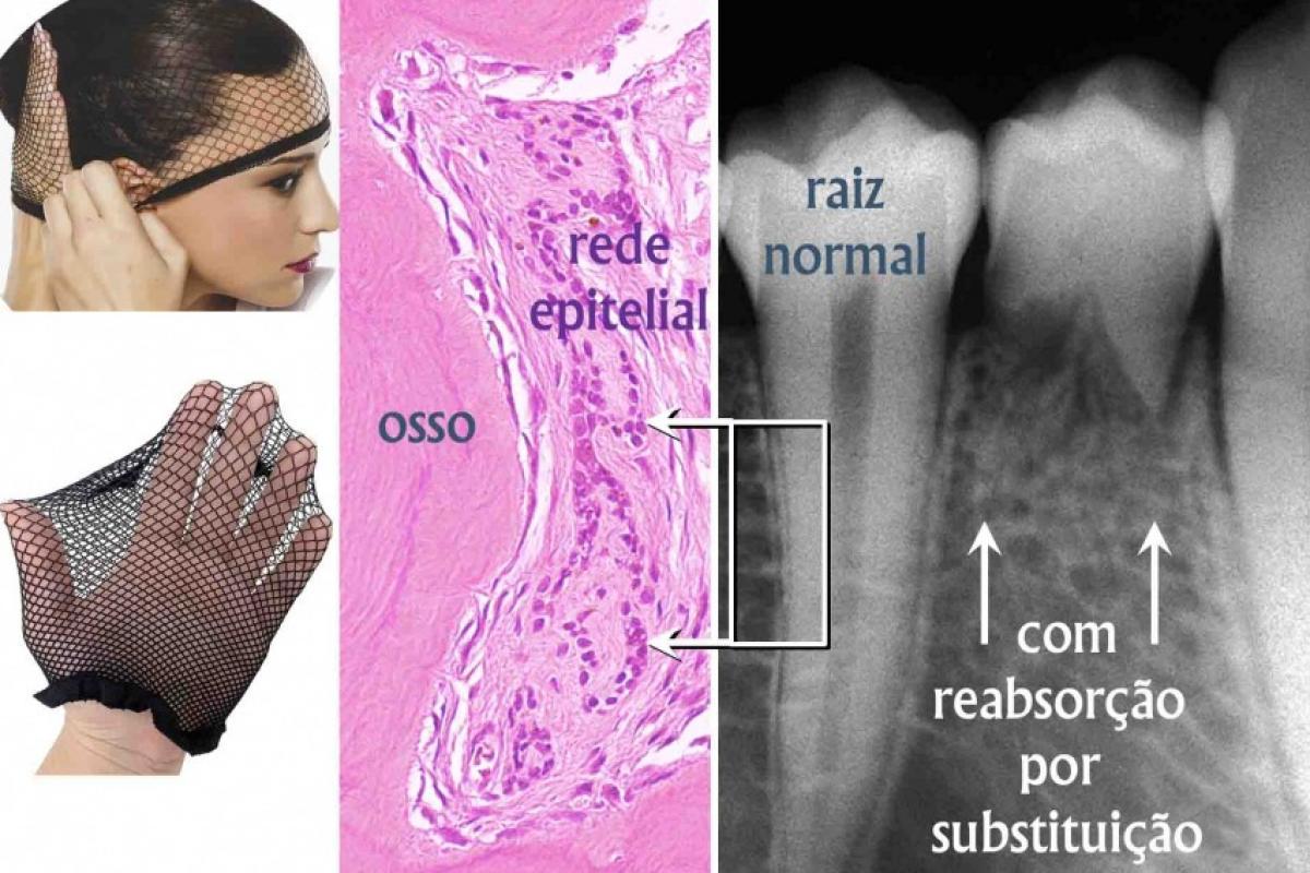 Dente traumatizado reabsorve e o osso substitui