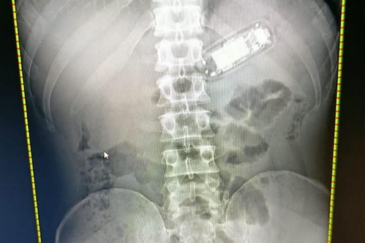 Detento não consegue expelir celular e é preso no PSC de Bauru